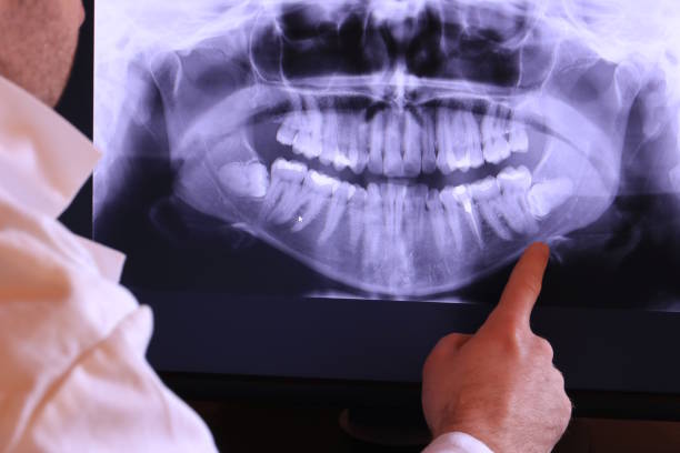 Best Emergency Wisdom Teeth Removal in Cody, WY